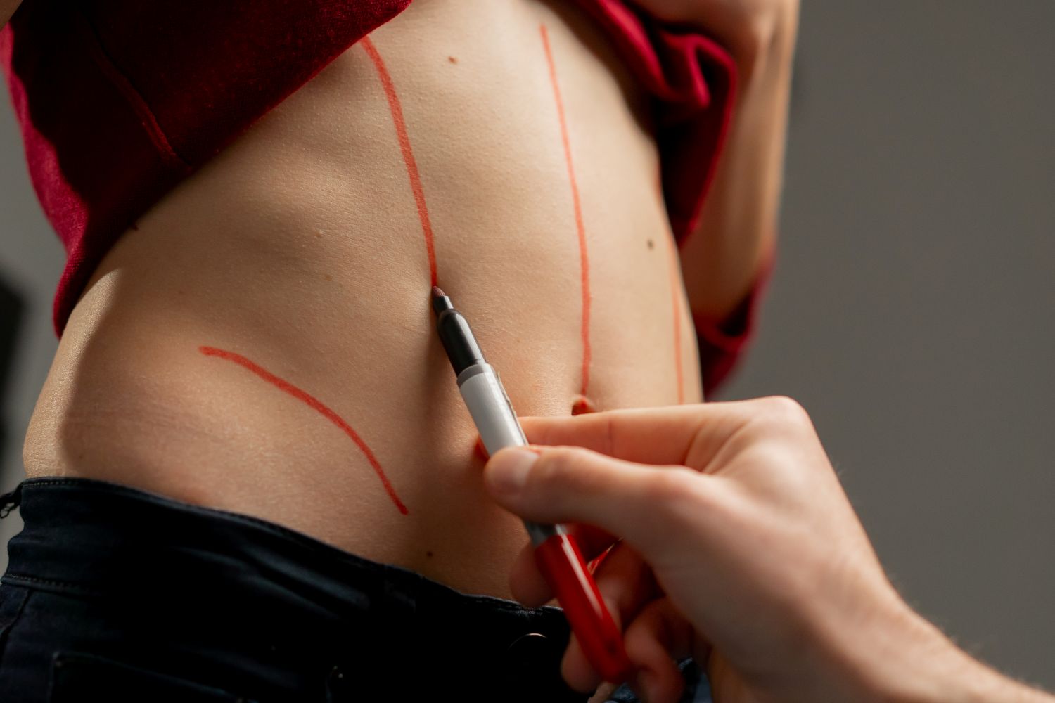 doctor preparing for liposuction